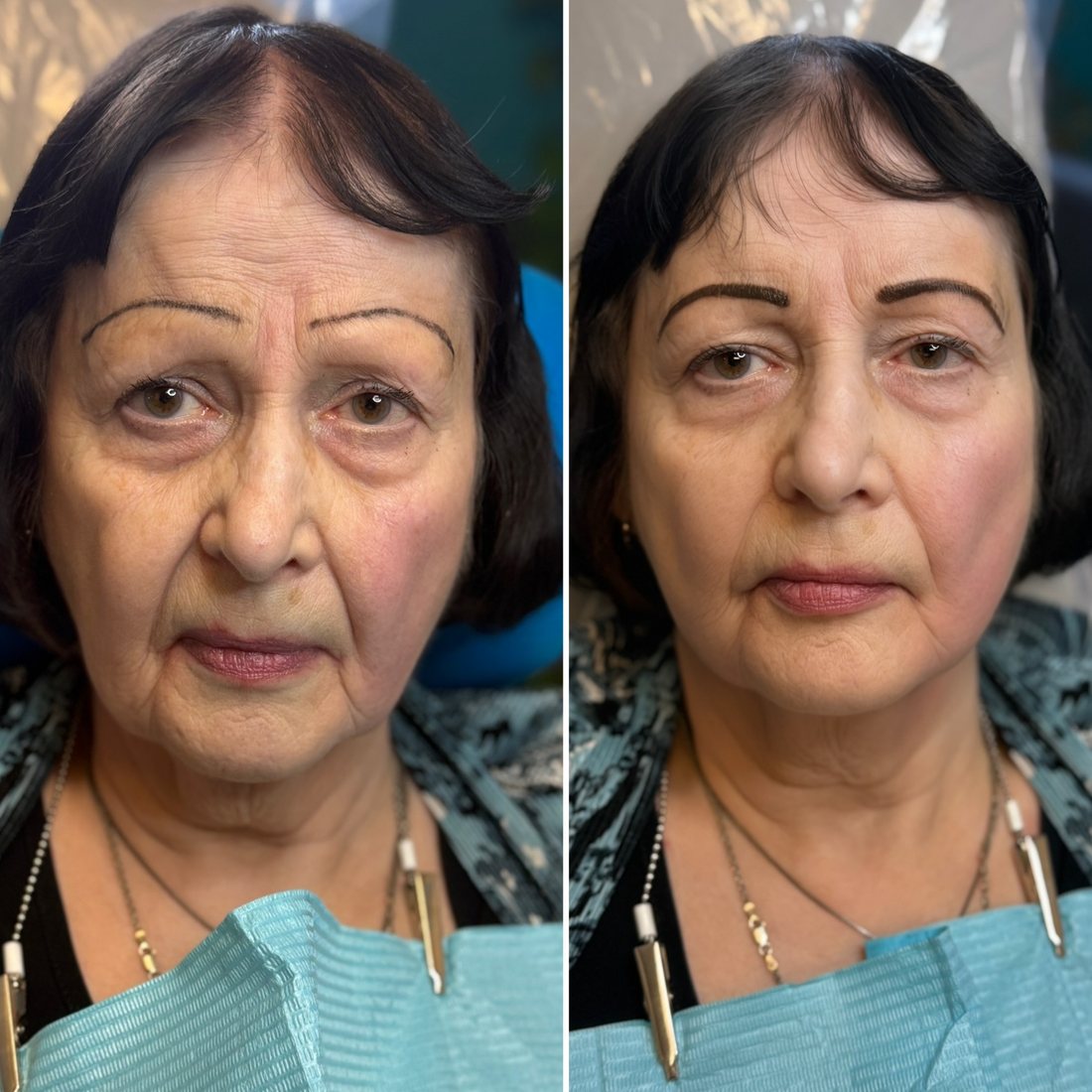 Brow correction before and after, hard dark tattooed brows softened into a natural shape